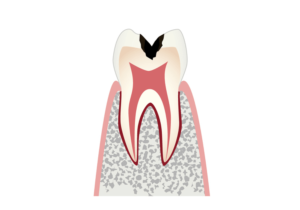 象牙質＝エナメル質のすぐ下にあり神経を守っている組織のむし歯